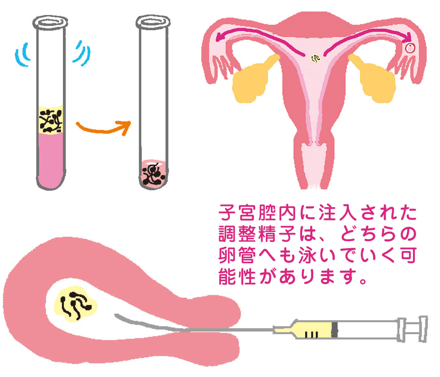 人工 授精 成功 の 秘訣