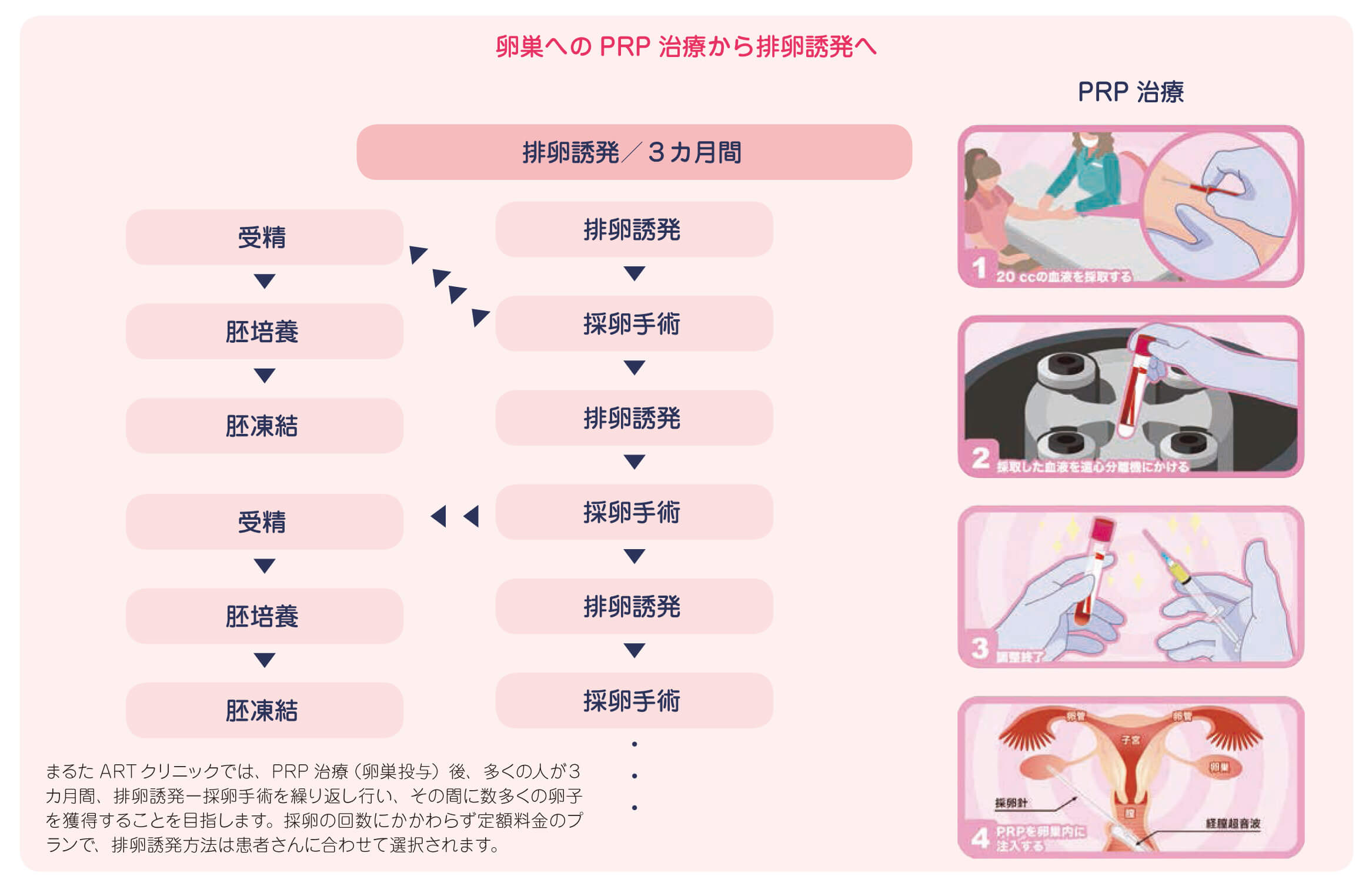 卵巣へのPRP治療から排卵誘発へ